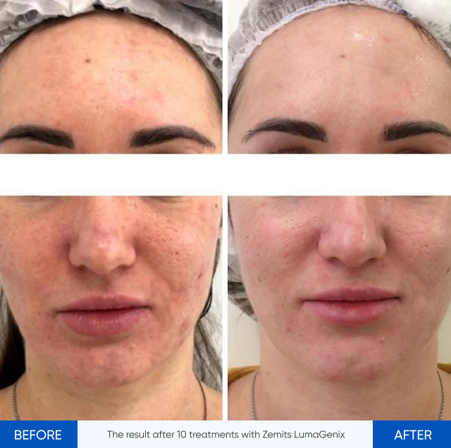 Zemits LumaGenix PDT Profesionálne LED zariadenie na svetelnú terapiu