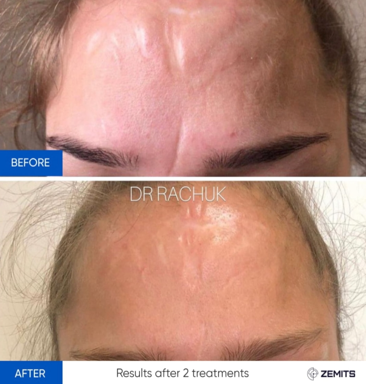 Zemits CarbonFrax Pro: CO2 frakčný laser