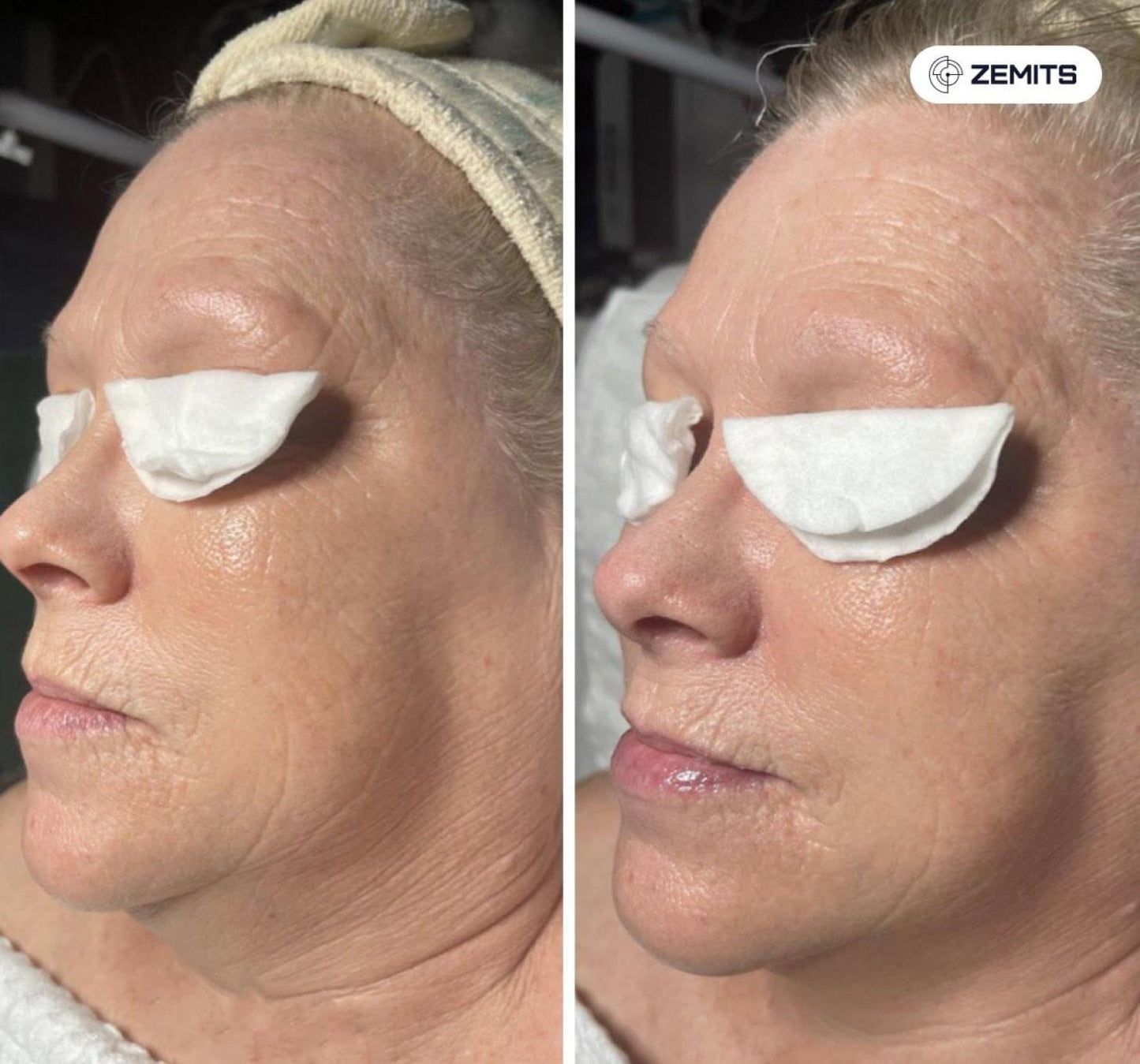 Zemits Klein EL Elektroporačný systém