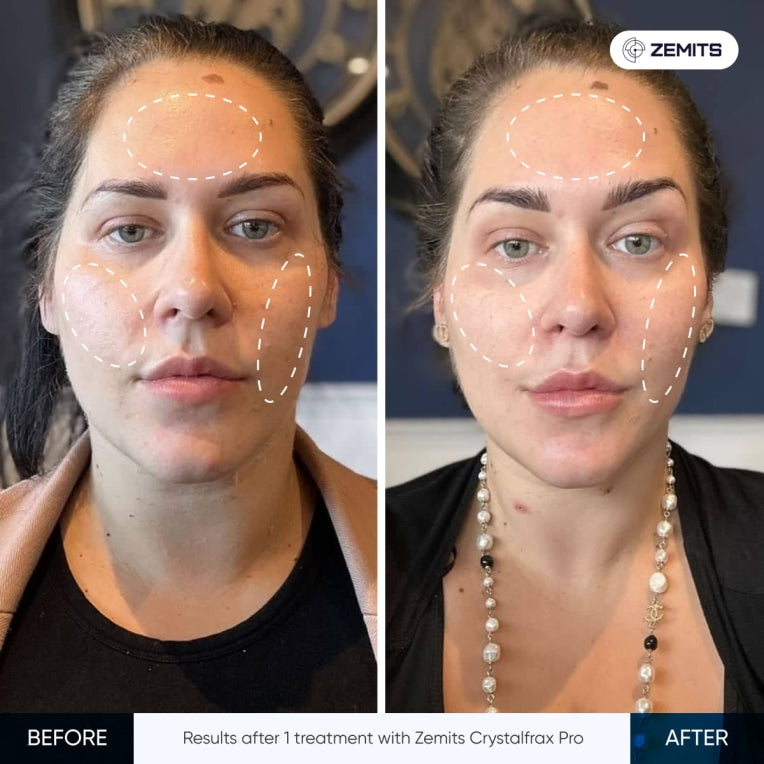 Zemits CrystalFrax PRO Neinvazívny frakčný RF systém